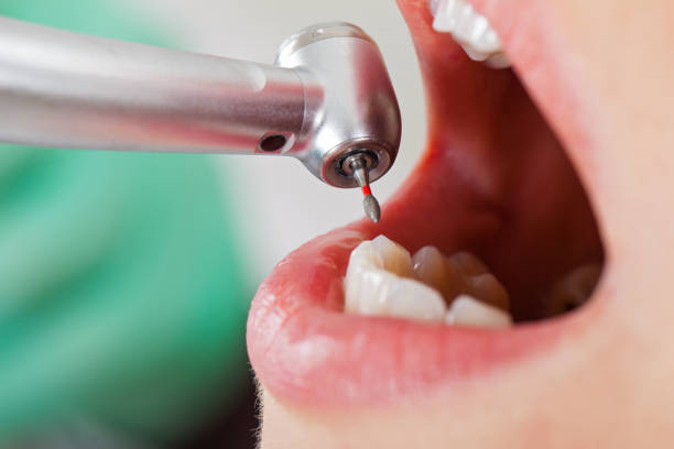 Best Emergency Tooth Extraction in Stro Valley, CA